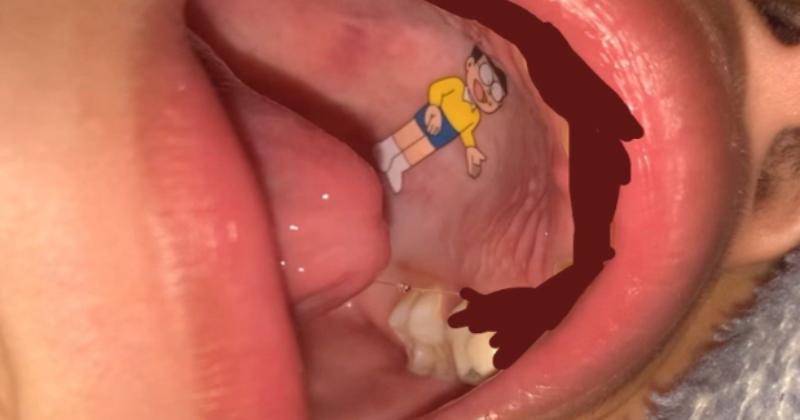 Viral Anak Pasang Stiker di Langit-Langit Mulutnya